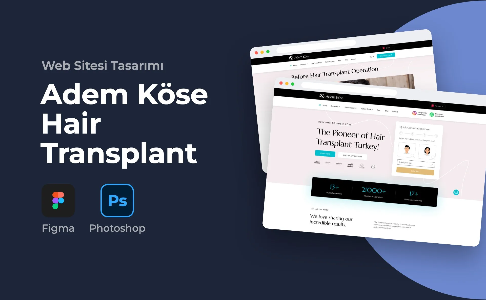 Adem Köse Hair Transplant — Kortex Digital